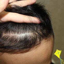 -大麦微针植发丨全国连锁