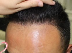 -大麦微针植发丨全国连锁