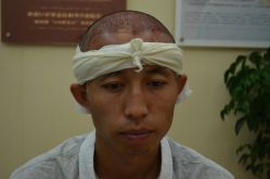 -大麦微针植发丨全国连锁