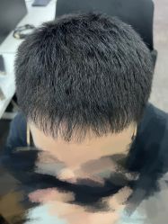 点击看大图 体验后-大麦微针植发丨全国连锁