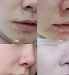 -苗方清颜痘肌研究所