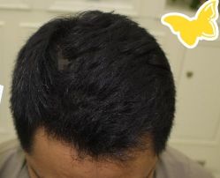 -大麦微针植发丨全国连锁