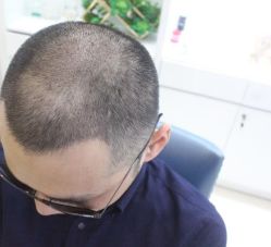 -大麦微针植发丨全国连锁