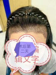 -大麦微针植发全国连锁