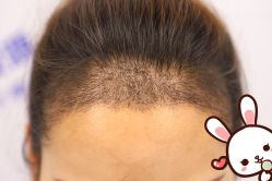 -大麦微针植发丨全国连锁