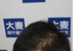 -大麦微针植发丨全国连锁