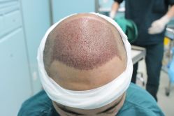 点击看大图 -大麦微针植发丨全国连锁