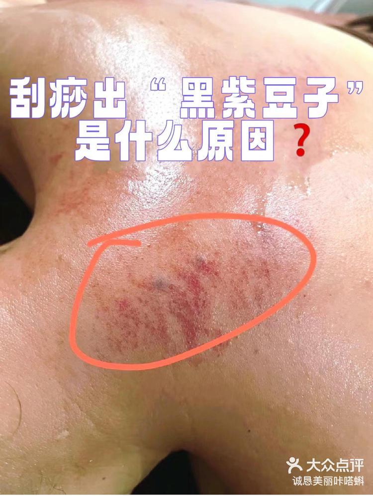 好多人刮出来的痧是那种发黑发紫的颜色