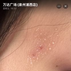体验后-泉州欧菲医疗美容