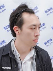 -大麦微针植发丨全国连锁