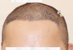 -大麦微针植发全国连锁