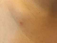 同事入住第一晚被不知名小虫咬岀红疙瘩-全季酒店(上海徐家汇肇嘉浜路店)