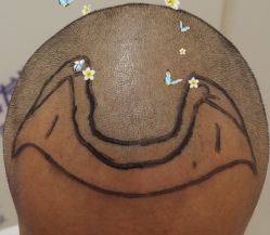 -大麦微针植发全国连锁