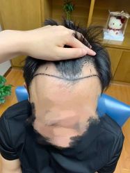 体验前-大麦微针植发全国连锁