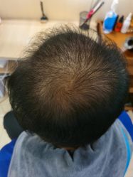 -碧莲盛·不剃发植发