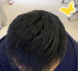 -大麦微针植发丨全国连锁