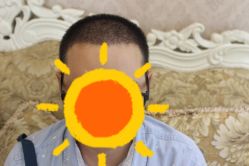 -大麦微针植发全国连锁