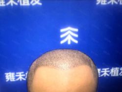 -雍禾植发全国连锁