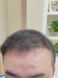 -大麦微针植发丨全国连锁
