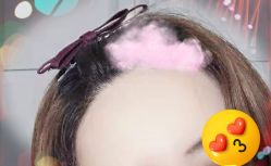 -大麦微针植发全国连锁