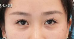 -天津健丽·去眼袋医疗美容机构