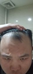 -碧莲盛·不剃发植发