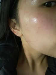 -爱莎扁平疣·汗管瘤·斑痣中心