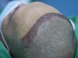 点击看大图 体验后-大麦微针植发丨全国连锁