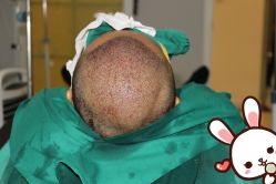 点击看大图 -大麦微针植发丨全国连锁