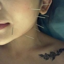 -肥三针腧穴瘦身馆