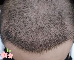 -大麦微针植发丨全国连锁