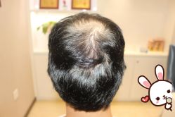 -大麦微针植发丨全国连锁