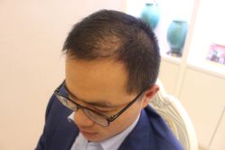 -大麦微针植发丨全国连锁