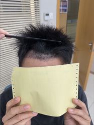 点击看大图 -大麦微针植发丨全国连锁