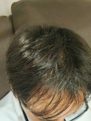 -碧莲盛·不剃发植发