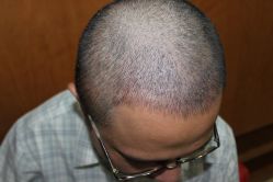 点击看大图 -大麦微针植发丨全国连锁