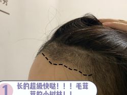 -碧莲盛·不剃发植发