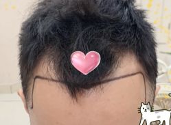 -大麦微针植发全国连锁