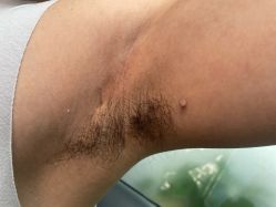 -清疣美疣·痣·斑净肤中心