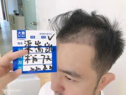 点击看大图 -大麦微针植发丨全国连锁