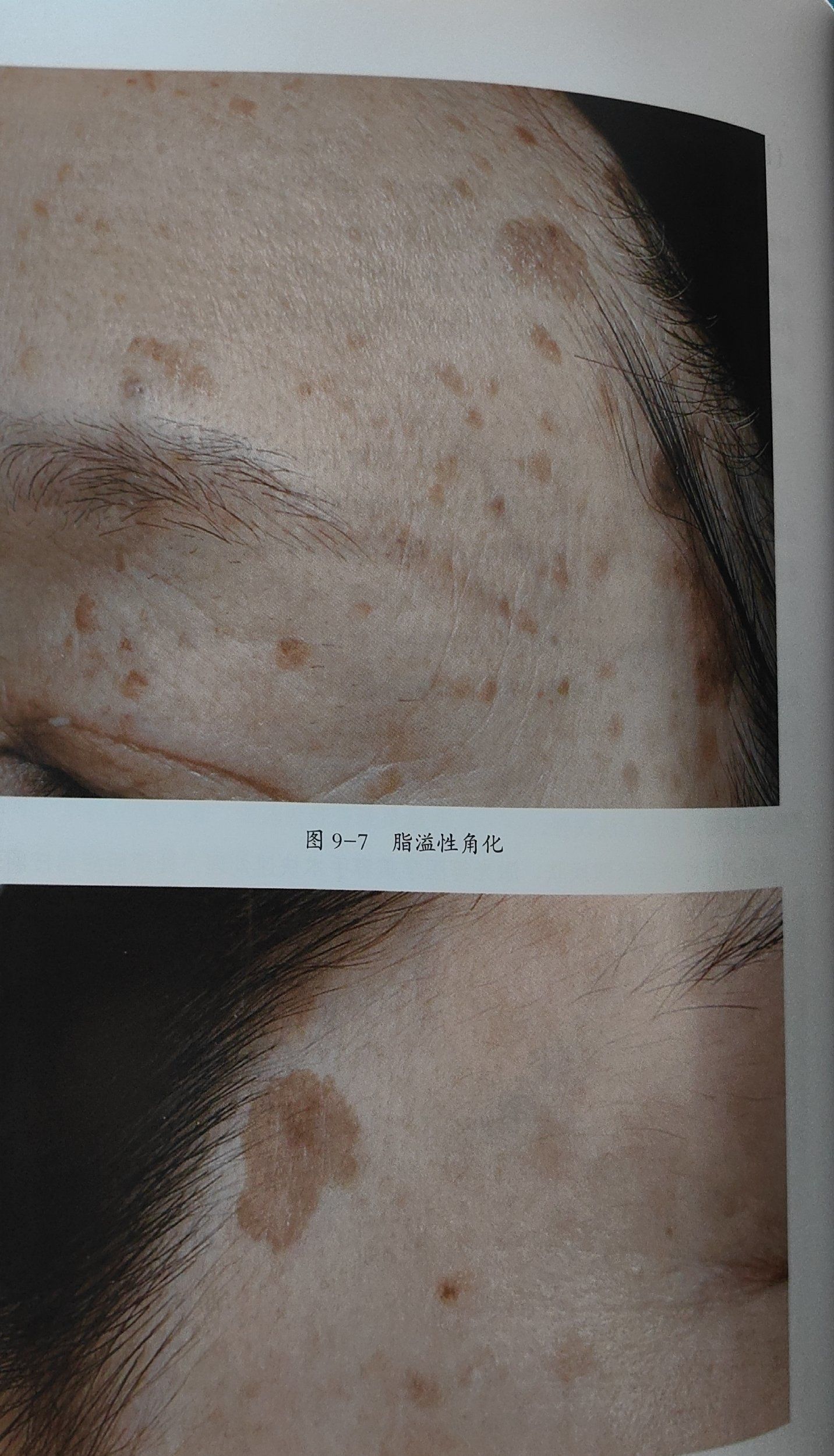 人为什么长老年斑