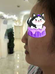 体验前-东莞西妃整形美容医院