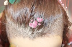 -大麦微针植发全国连锁