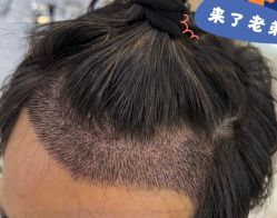 -大麦微针植发全国连锁