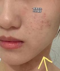 -美肤盾祛痘·问题肌头疗管理中心