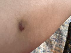 -杭州仁易堂中医康复医院疤痕修复