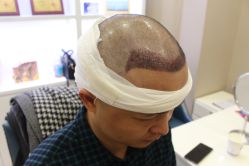 -大麦微针植发丨全国连锁