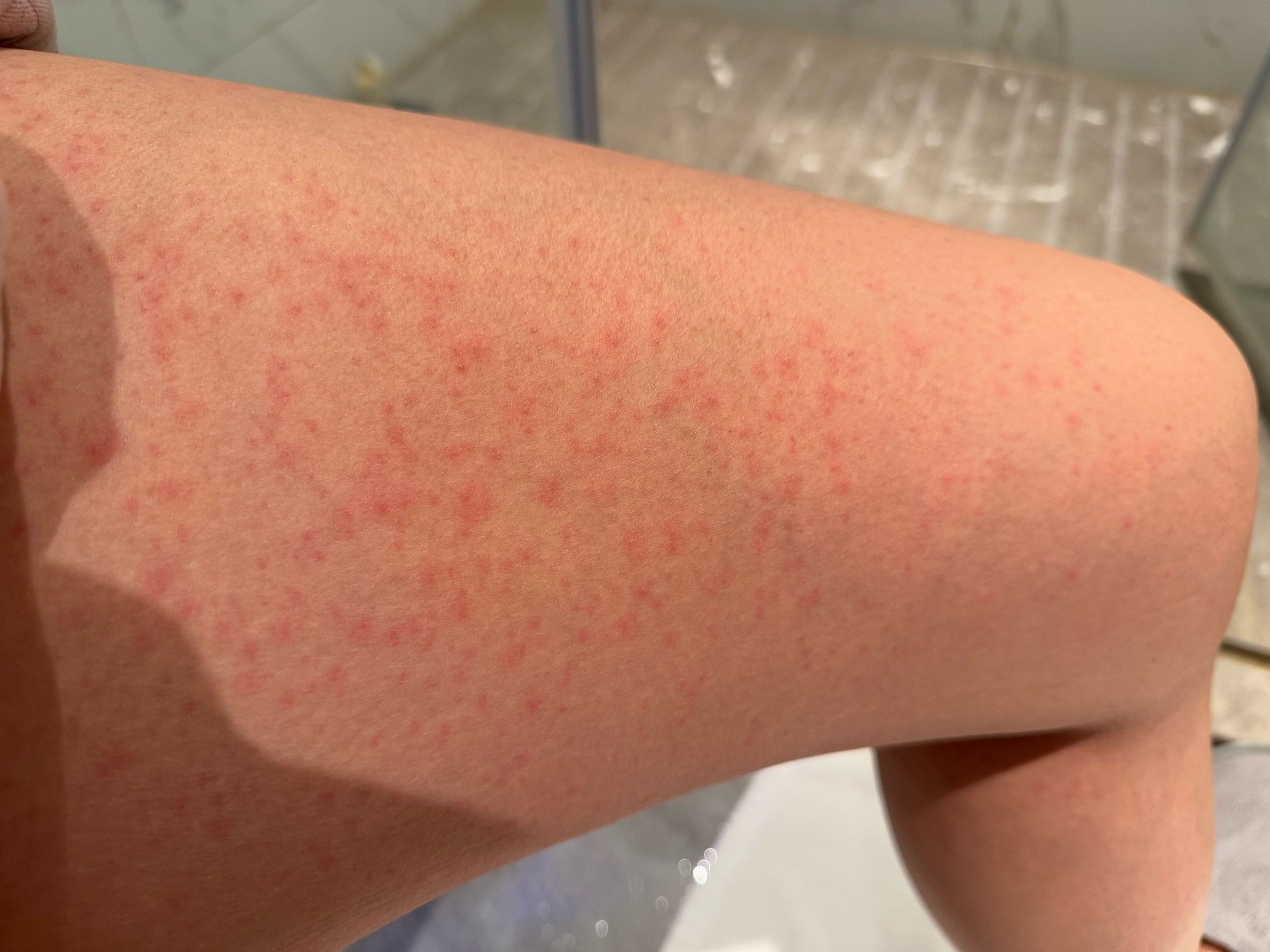 太阳谷搓澡,全身过敏过敏过敏!