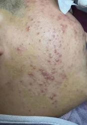 -苗方清颜专业祛痘连锁机构