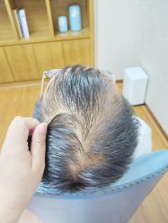 -大麦微针植发全国连锁